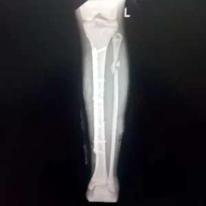 cirugia con placa bloqueada angosta innoblox