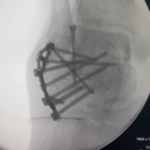 cirugía placa de calcaneo