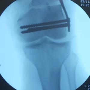 cirugía placa de femur distal