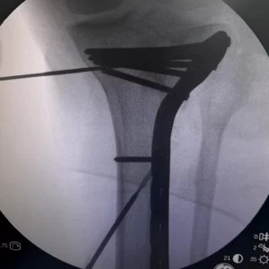 cirugia placa de palo de golf de 3.5