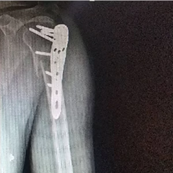 cirugia placa humero proximal