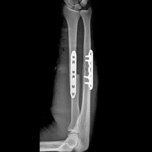 cirugia con placa innoblox 3,5 bloqueada