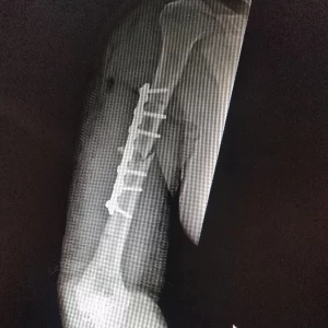 cirugia placa innoblox de 3.5