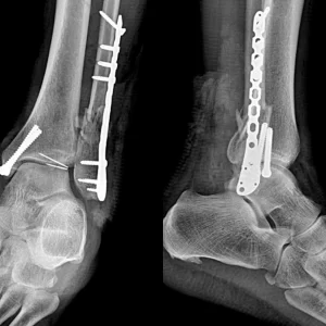 cirugia con placa perone distal lateral