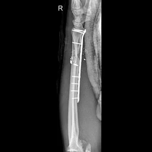 cirugia placa radix large plus