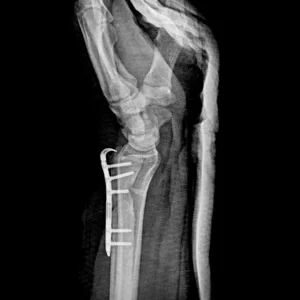 cirugia placa radix plus cubital