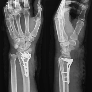 cirugia placa radix plus ultra