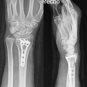 cirugia placa radix plus volar