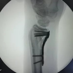 cirugia placa radix plus yuxta