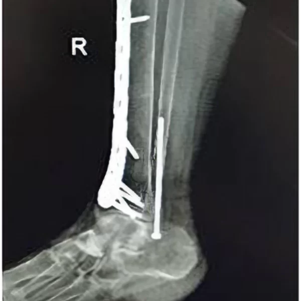 cirugia placa tibia distal medial